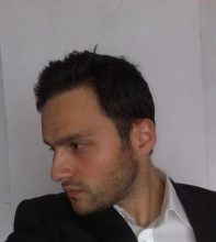 hair transplant turkey before after (1)