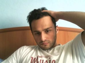 hair transplant turkey before after (10)