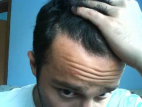 hair transplant turkey before after (11)