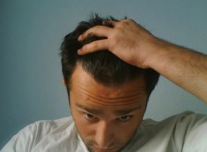 hair transplant turkey before after (12)