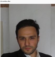 hair transplant turkey before after (15)