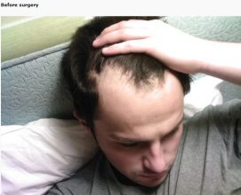 hair transplant turkey before after (2)
