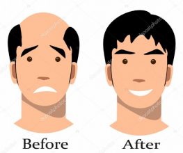 hair transplant turkey before after