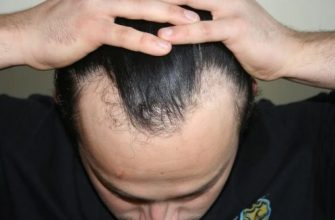 hair-transplant-turkey-before-after