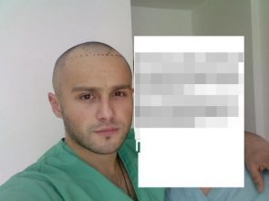 hair transplant turkey before after (4)
