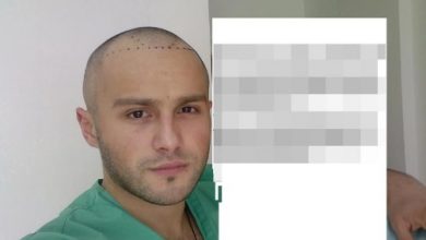 hair transplant turkey before after (4)