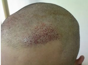 hair transplant turkey before after (5)