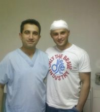 hair transplant turkey before after (7)