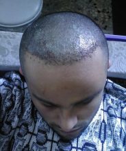 hair transplant turkey before after (8)