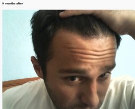 hair transplant turkey before after (9)