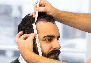 how is hair transplant in turkey
