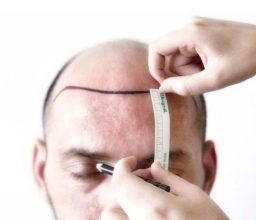 how much hair transplant in Turkey