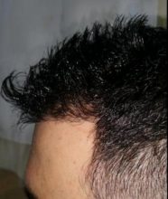 is hair transplant difficult (1)