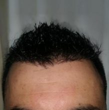is hair transplant difficult (10)