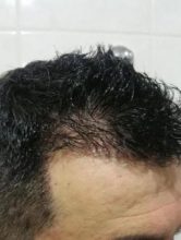 is hair transplant difficult (2)