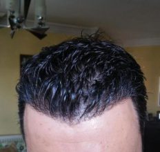 is hair transplant difficult (3)