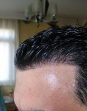 is hair transplant difficult (4)