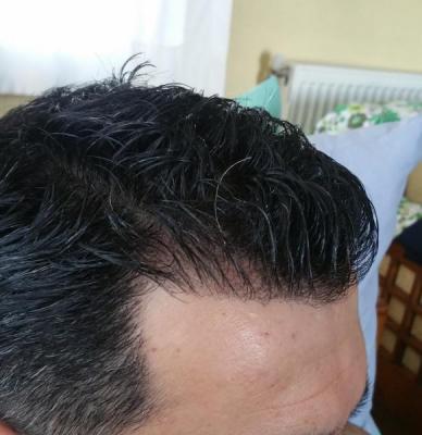 is hair transplant difficult (5)