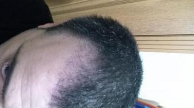 is hair transplant difficult (6)
