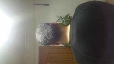 is hair transplant difficult (8)