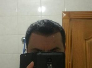 is hair transplant difficult (9)