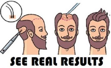 hair-transplant-in-turkey