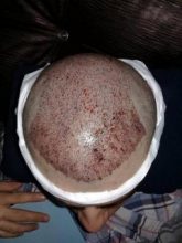 Hair-implants-turkey (10)