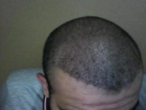 Hair-implants-turkey (11)