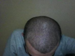 Hair-implants-turkey (12)