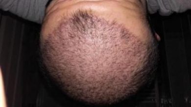 Hair-implants-turkey (13)
