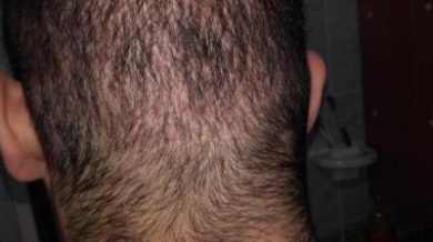 Hair-implants-turkey (14)