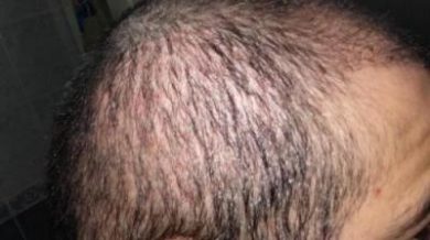 Hair-implants-turkey (15)
