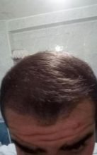 Hair-implants-turkey (16)