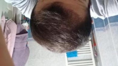 Hair-implants-turkey (17)