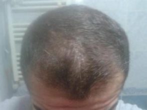 Hair-implants-turkey (18)