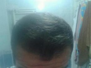 Hair-implants-turkey (19)