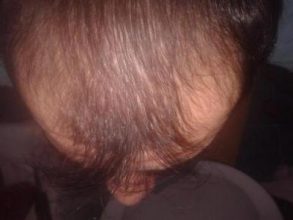 Hair-implants-turkey (2)