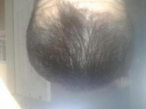 Hair-implants-turkey (20)