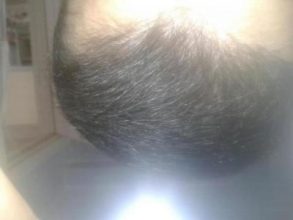 Hair-implants-turkey (21)