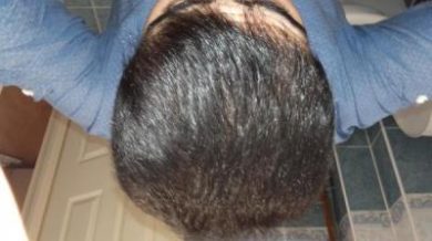 Hair-implants-turkey (23)