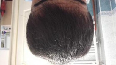 Hair-implants-turkey (24)