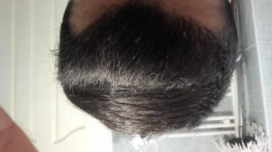 Hair-implants-turkey (25)