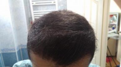 Hair-implants-turkey (26)
