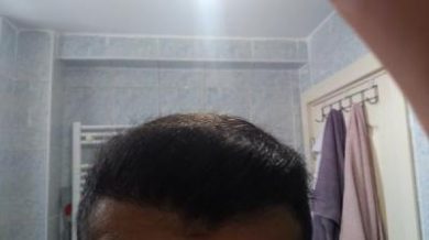 Hair-implants-turkey (28)