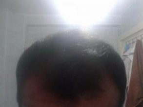 Hair-implants-turkey (3)
