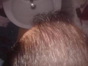 Hair-implants-turkey (4)
