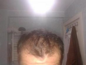 Hair-implants-turkey (5)