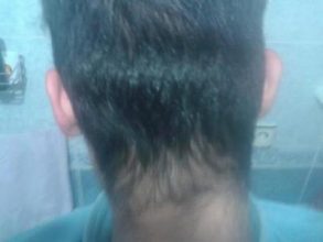 Hair-implants-turkey (6)