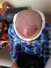 Hair-implants-turkey (7)