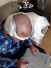 Hair-implants-turkey (8)